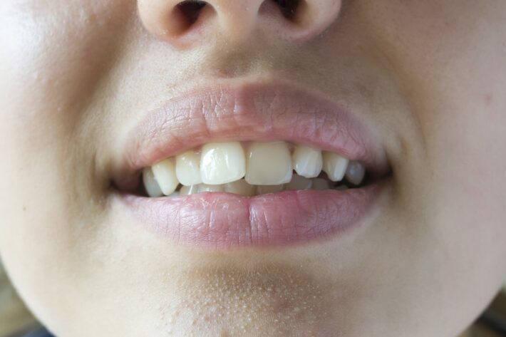 Crooked Teeth 1 - What Causes Crooked Teeth & Treatment Solutions